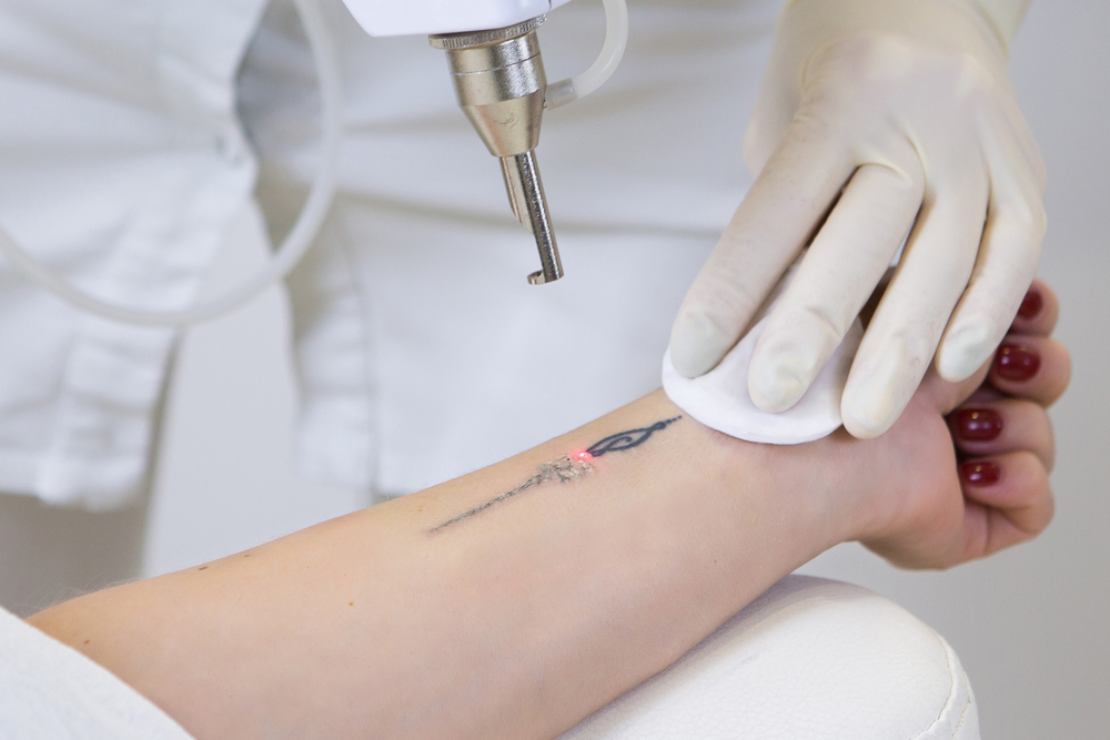 Best Laser Tattoo Removal Auckland NZ | Cheap Tattoo Removal Auckland Cost | Lasertech Cosmetic Clinics