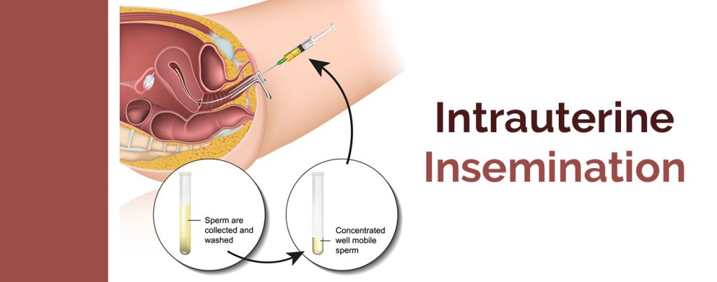 Best IUI Treatment Center in Gurgaon | Intrauterine Inseminaiton