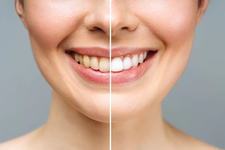 Crest Whitestrips Hacks: Tips from Dental Experts