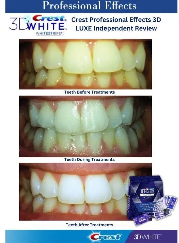 Before and After: Real Results with Crest Whitening Strips