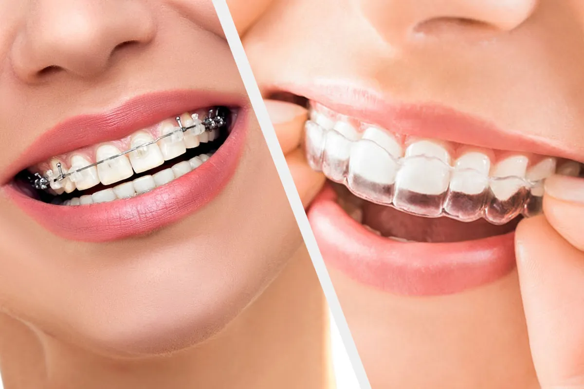 Invisalign Provider in RR Nagar — Symphony Smiles Dental | by Symphonysmiles | Jul, 2025 | Medium