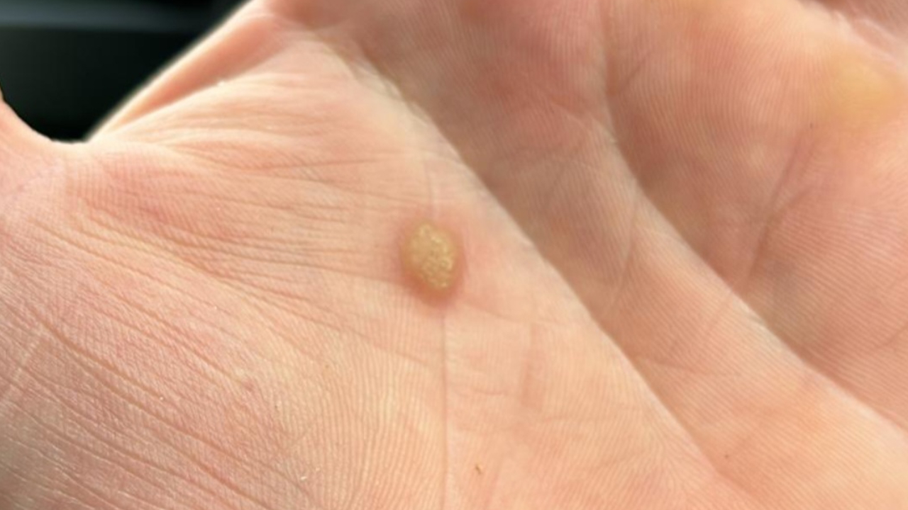 Wart Causes and Prevention: Expert Tips for Clear Skin