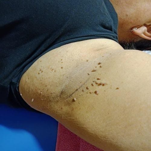 When Should You Consider Skin Tag Removal? | by A.H.Advanced Skin Specialist | Jul, 2025 | Medium