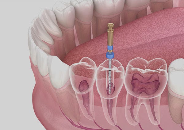 Root Canal Treatment. Oral health is an essential part of… | by Symphonysmiles | Sep, 2025 | Medium