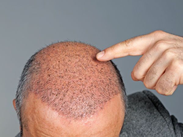 Synthetic Hair Transplants In Zirakpur | Mahendra Hair and Skin