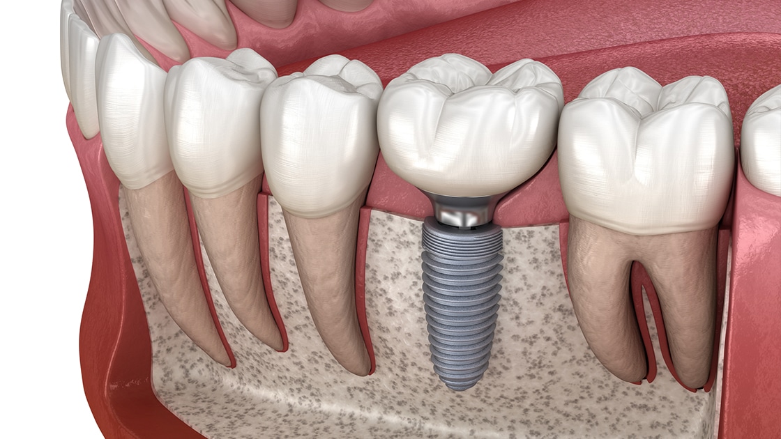 Dental Implant Specialists Long Island | Massapequa