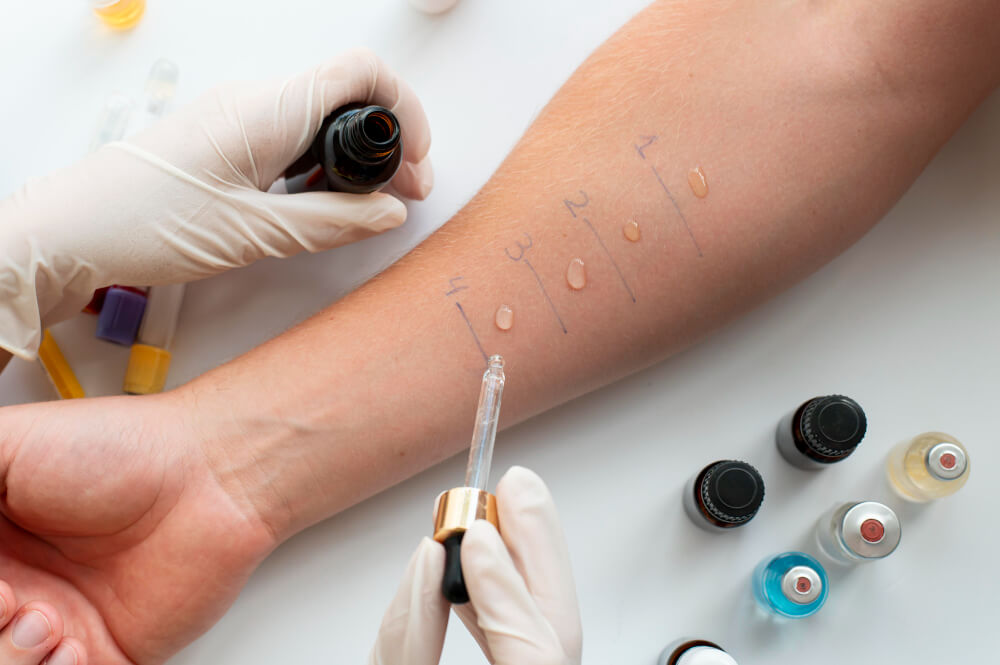 Private Allergy Testing Knaresborough, UK – Accurate Results
