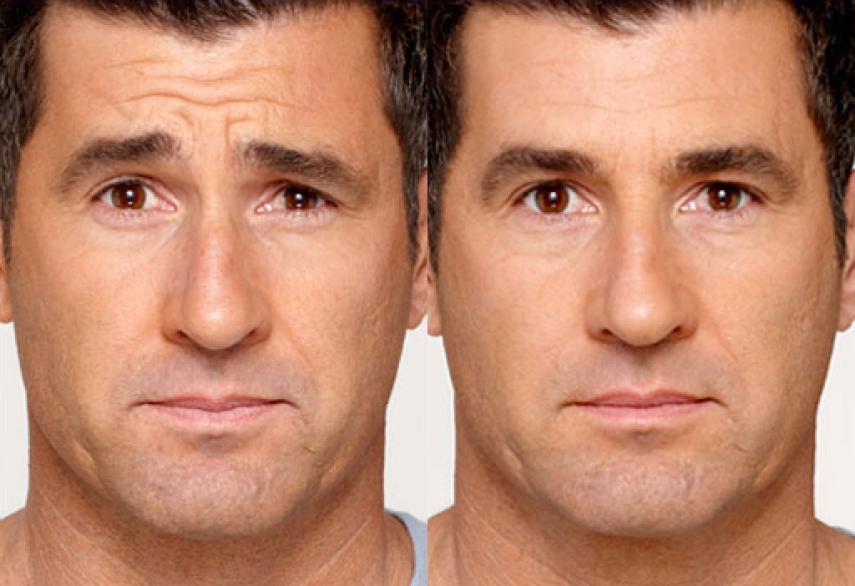 Botox Injections in Zirakpur | Mahendra Hair and Skin