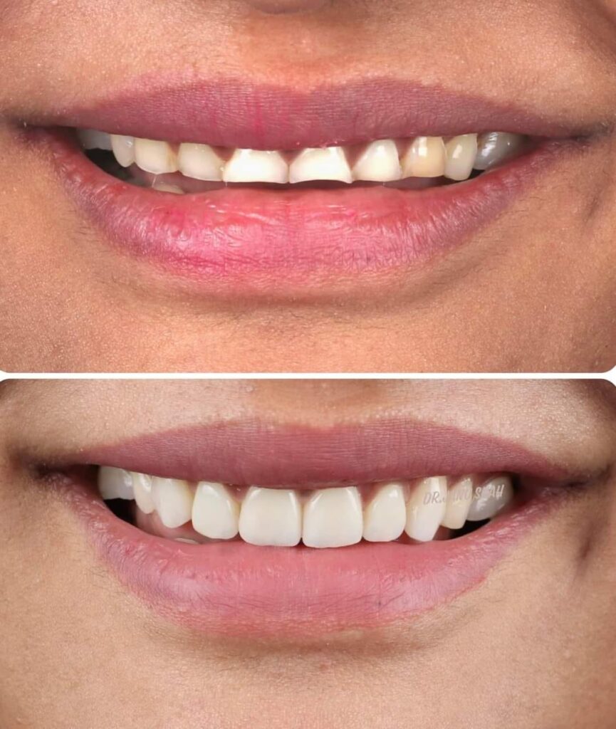 Best Smile Designing Treatment in Madhapur | Olive's Dental World