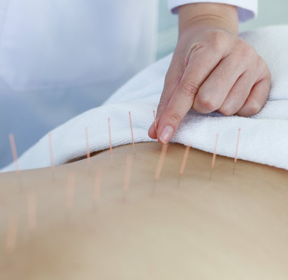 Acupuncture for Stress Relief