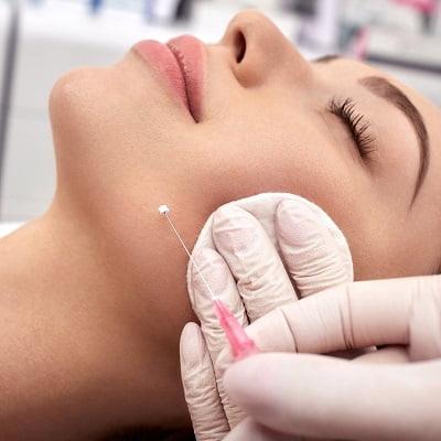 Thread lift Treatment in Islamabad, Pakistan