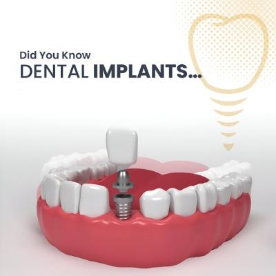 Dental Implant in Islamabad | ERC